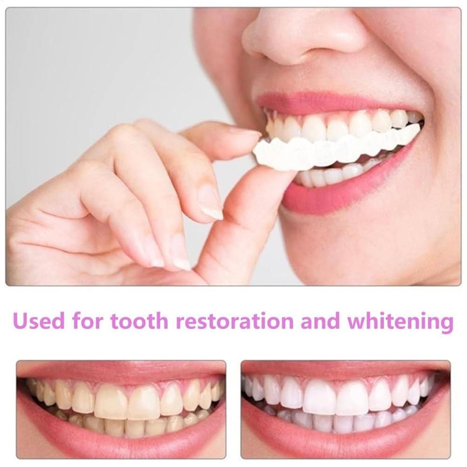 Teeth Whitening Instant - 1 paar Langdurige Facings Tanden Whitening