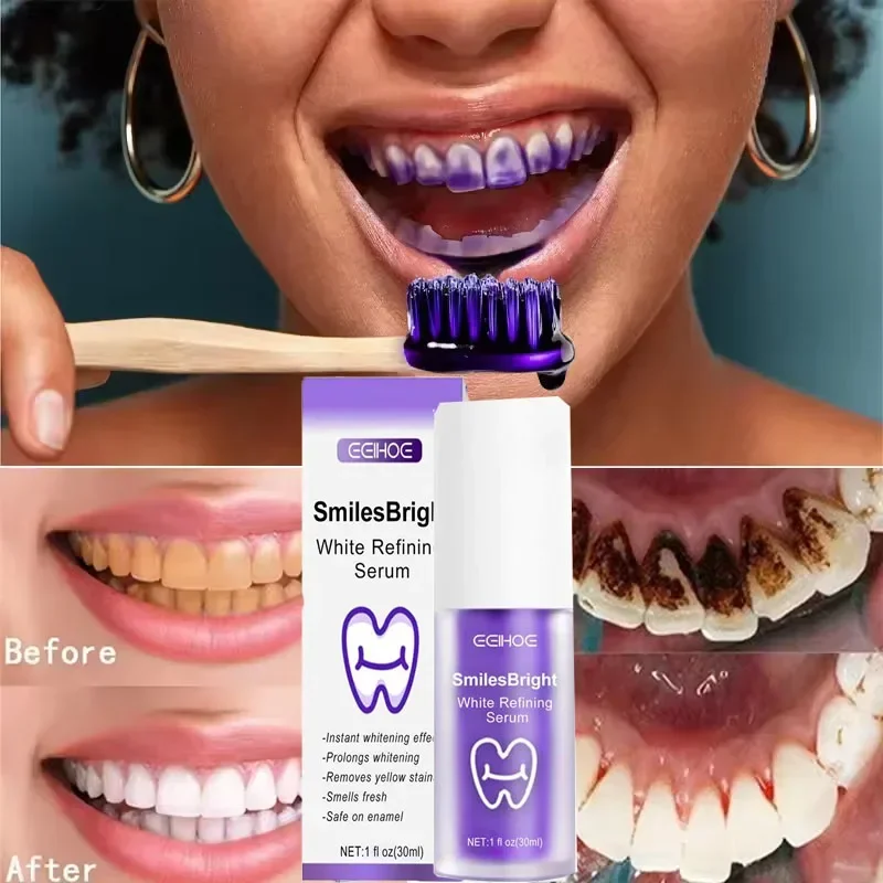 Tanden Reiniging Whitening Tan - Teeth Whitening Korea recensie en prijs