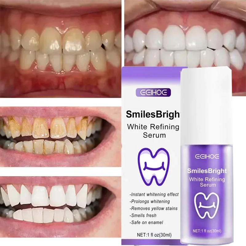 Tanden Reiniging Whitening Tan - Teeth Whitening Korea recensie en prijs