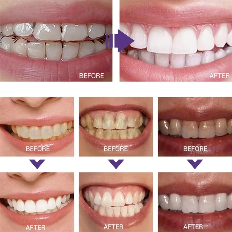 Tanden Reiniging Whitening Tan - Teeth Whitening Korea recensie en prijs
