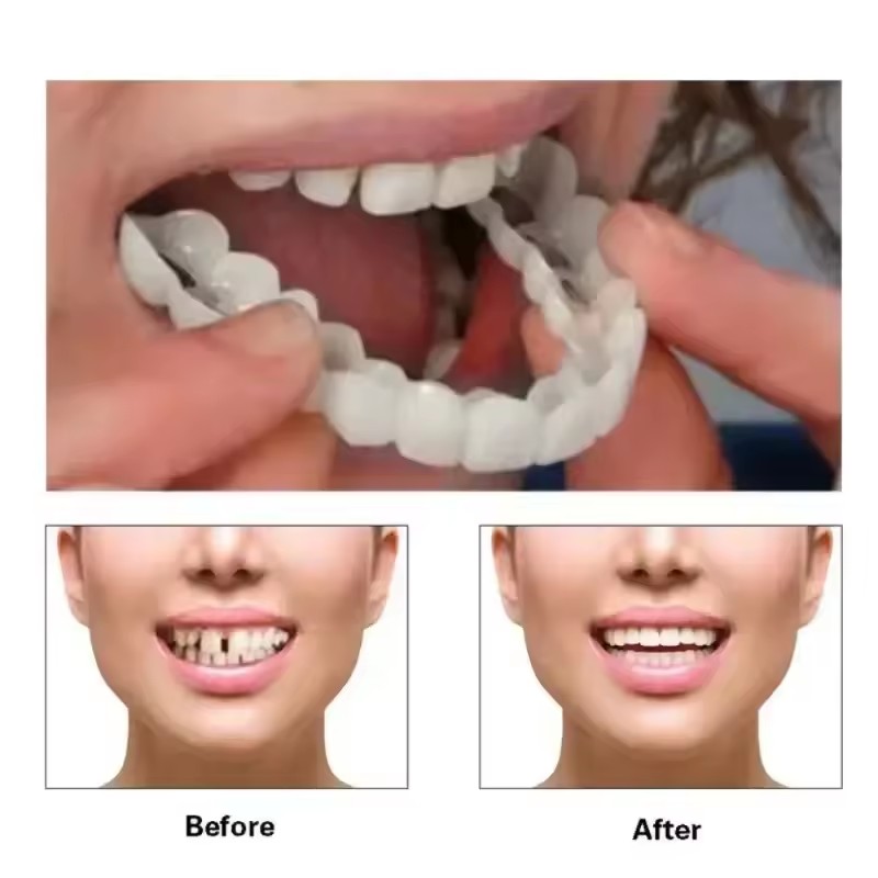 Tanden Veneers Bleekmiddelen P - Teeth Whitening Vape recensie en prijs