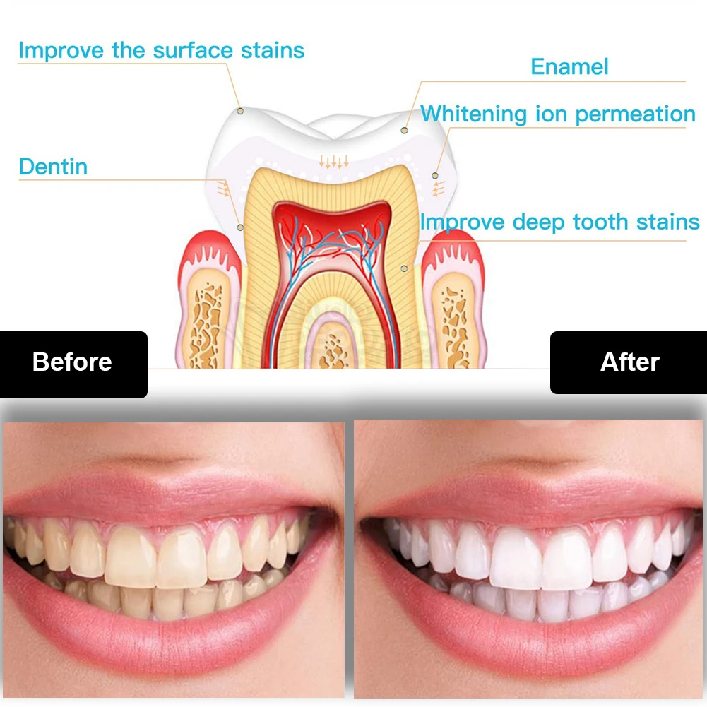 Tandheelkundige Tanden Whiteni - Teeth Whitening App recensie en prijs